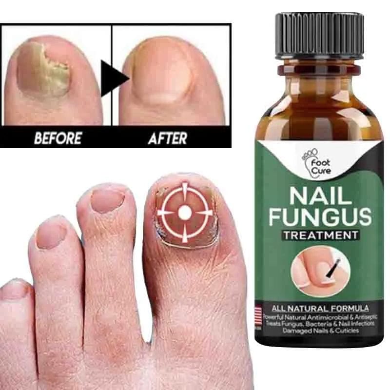 Nail Fungus Treatment Oil (Imported)